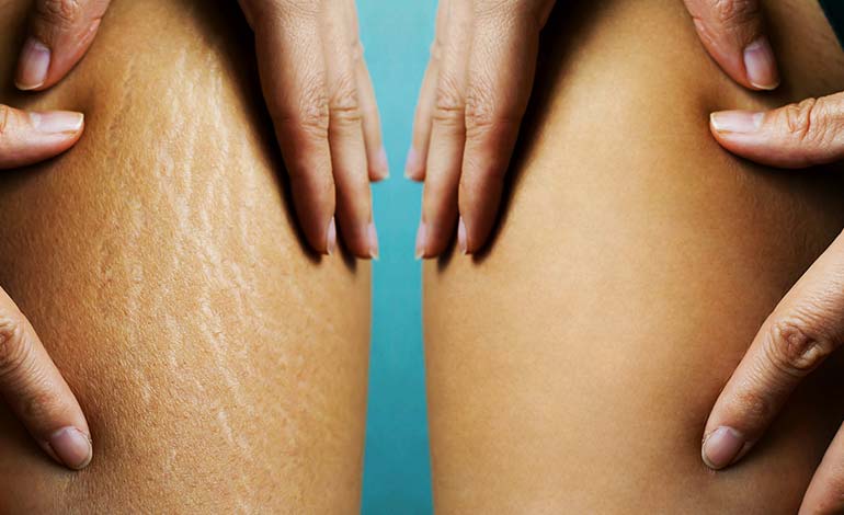 stretch marks comparison