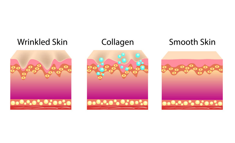 before vs. after collagen