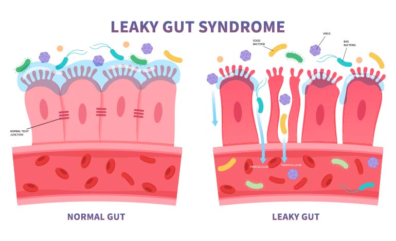 normal vs leaky gut