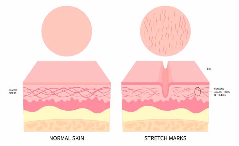 causes of stretch marks