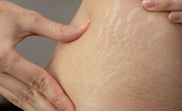 causes of stretch marks