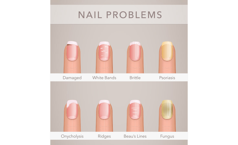 common nail problems